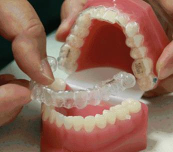 Invisalign[mCrۆ᣿